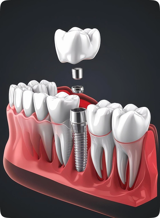 Exploded view of dental implant showing implant post abutment and crown placement