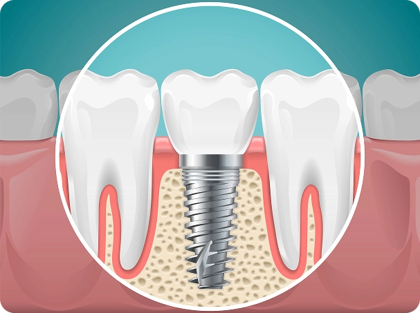 Dental implant integrated into the jawbone between natural teeth for stable tooth replacement