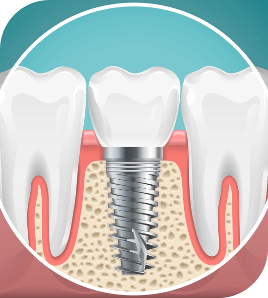 Dental implant supporting a replacement tooth positioned between natural teeth in the jawbone