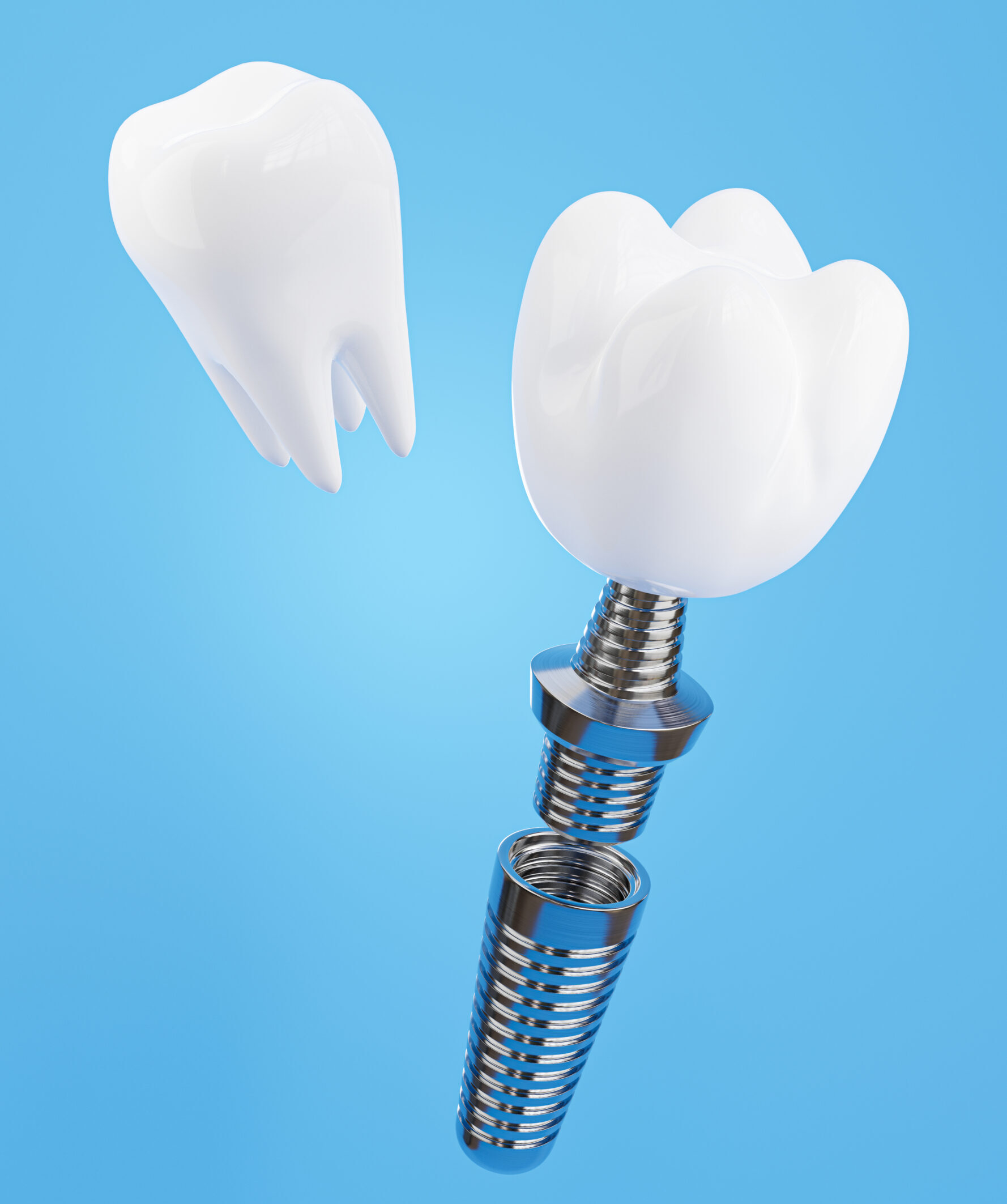 A dental professional presenting full mouth dental implants for patients in Baton Rouge, LA