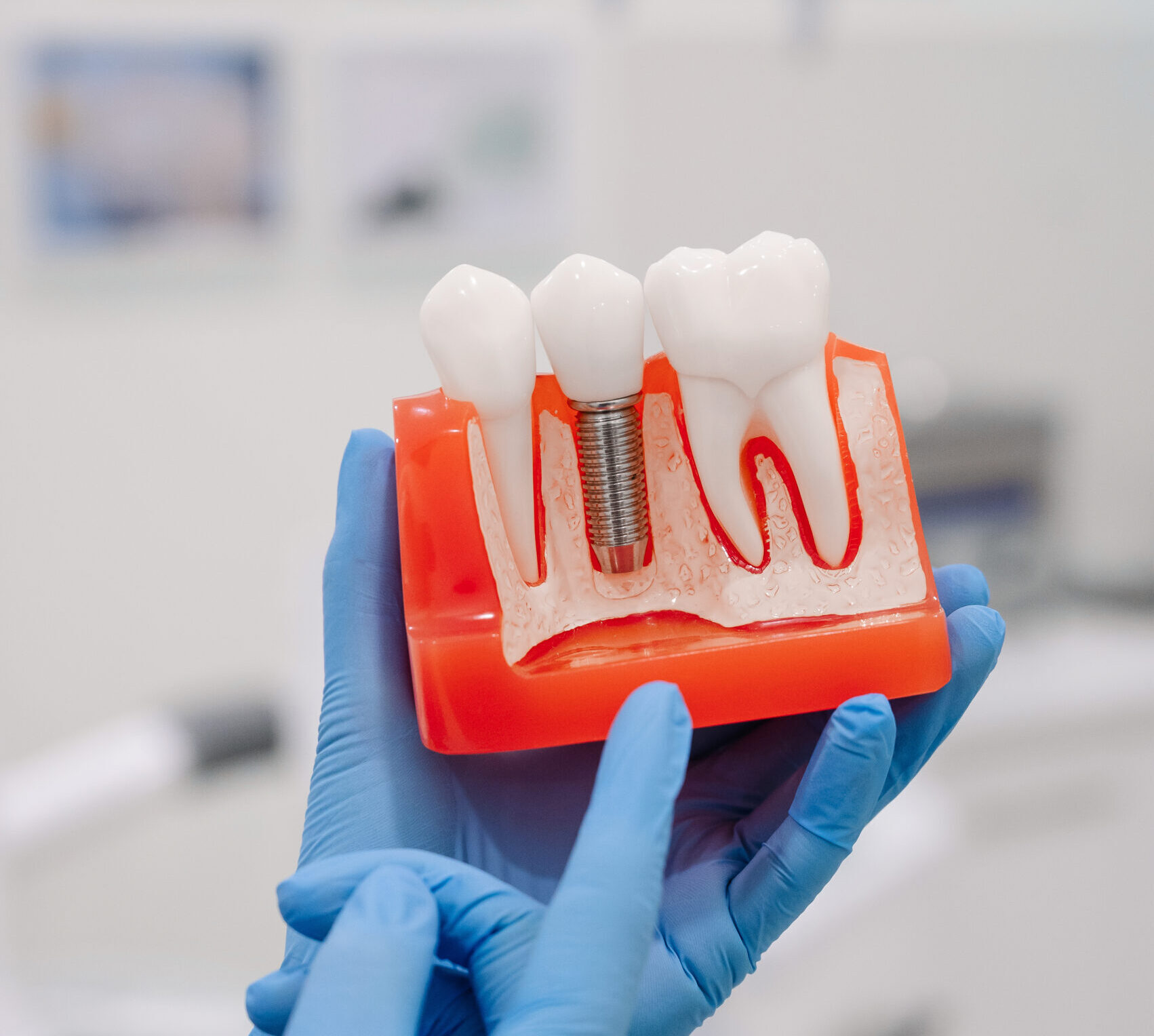 A dentist highlighting full mouth dental implant treatment in Baton Rouge, Louisiana