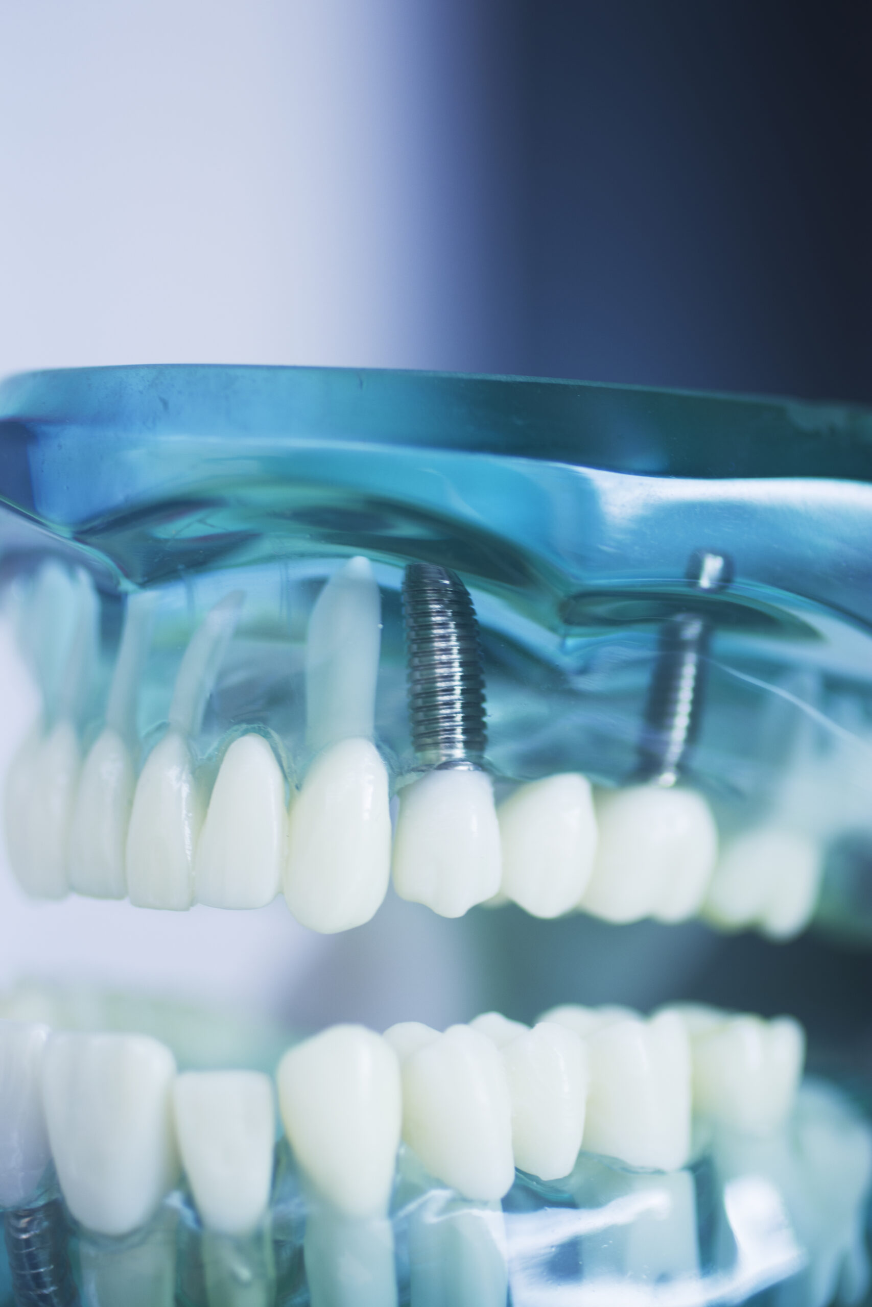 A blue model of all-on-x dental implants in Baton Rouge, LA