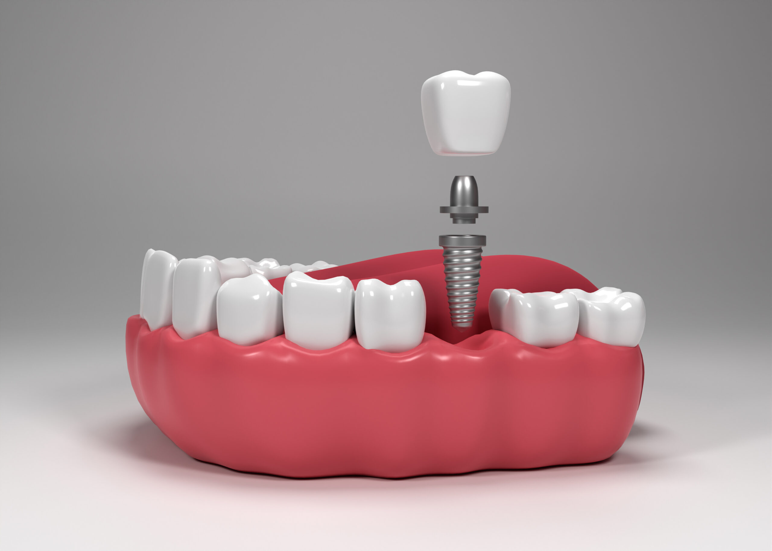 Full-mouth dental implants in denham springs, la